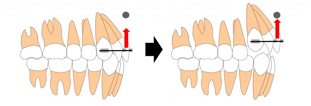 部分矯正の歯科矯正用アンカースクリューによる上方牽引