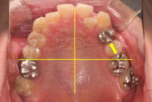 大臼歯の近心移動による側切歯舌側転位