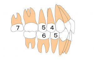 3級　CL3 上顎7番の対合歯がない