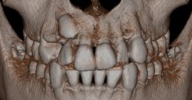 埋伏歯治療例１　術前CT画像１