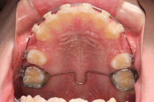 上顎前突治療例10 治療経過上顎