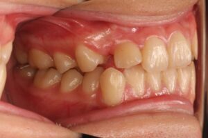 埋伏歯治療例１　初診時右側面
