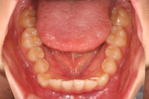 埋伏歯治療例１　初診時下顎