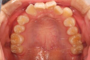 埋伏歯治療例１　初診時上顎