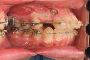埋伏歯治療例１　治療中右側面