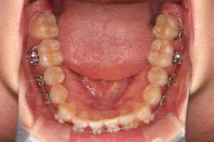 埋伏歯治療例１　治療中下顎