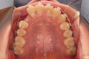 埋伏歯治療例１　治療中上顎