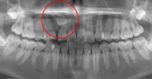 埋伏歯治療例１　術前パントモ