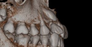 埋伏歯治療例１　術前CT画像２