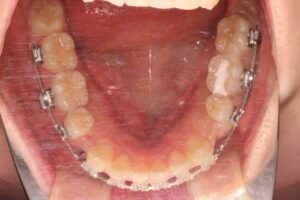 叢生治療例25　治療中下顎咬合面