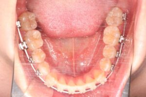 顎変形症治療例１　治療中下顎咬合面