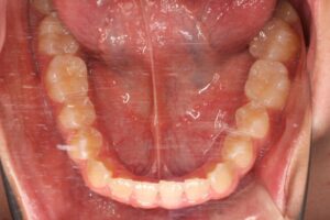 顎変形症治療例１　下顎咬合面