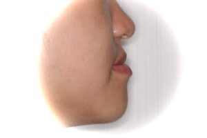 顎変形症治療例１　治療前側貌