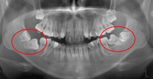 下顎第二大臼歯水平埋伏治療例１　初診時レントゲン