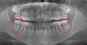 下顎第二大臼歯水平埋伏治療例１　終了時レントゲン
