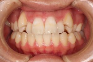 下顎第二大臼歯水平埋伏治療例１　初診時正面写真