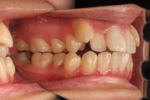 下顎第二大臼歯水平埋伏治療例１　初診時側面写真