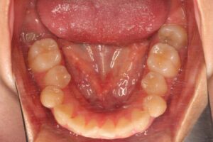 下顎第二大臼歯水平埋伏治療例１　初診時下顎咬合面写真