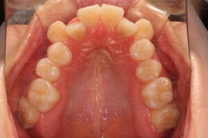 第二大臼歯の水平埋伏治療例１　初診時上顎咬合面写真