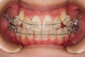 下顎第二大臼歯水平埋伏治療例１　治療中正面写真