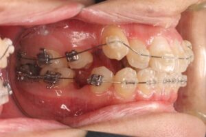下顎第二大臼歯水平埋伏治療例１　治療中側面写真