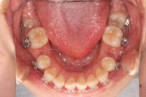 下顎第二大臼歯水平埋伏治療例１　治療中下顎咬合面写真