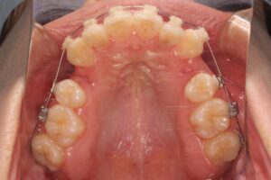 下顎第二大臼歯の水平埋伏治療例１　上顎治療中咬合面写真