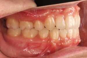 鋏状咬合歯列矯正治療例２　側面