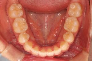下顎第二大臼歯水平埋伏治療例１　終了時下顎咬合面写真