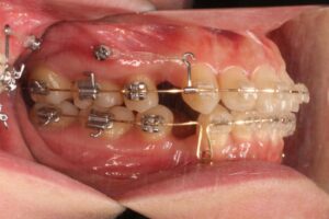 鋏状咬合歯列矯正治療例２　治療中側面