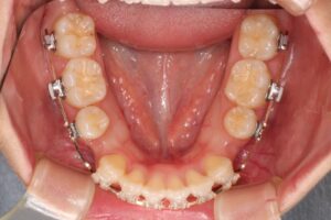 鋏状咬合歯列矯正治療例２　治療中下顎咬合面