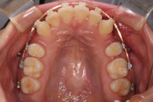 鋏状咬合歯列矯正治療例２　治療中上顎咬合面