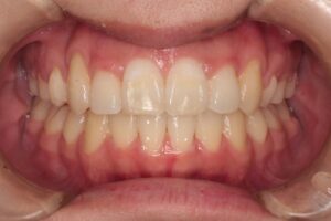 下顎第二大臼歯水平埋伏治療例１　治療後正面写真