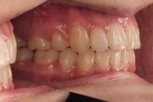 下顎第二大臼歯水平埋伏治療例１　終了時側面写真