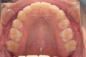 下顎第二大臼歯水平埋伏の治療例１　終了時上顎咬合面写真