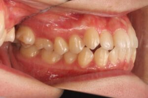鋏状咬合歯列矯正治療例２　初診時側面