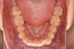 鋏状咬合歯列矯正治療例２　初診時下顎咬合面