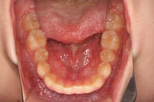 下顎前突治療例11　初診時下顎咬合面