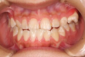 顎変形症の歯列矯正治療例2　初診時正面