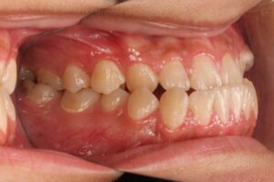 顎変形症の歯列矯正治療例2　初診時側面