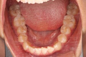 顎変形症の歯列矯正治療例2　初診時下顎咬合面