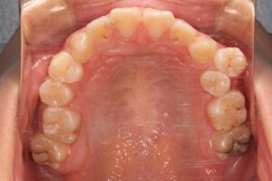 顎変形症の歯列矯正治療例2　初診時上顎咬合面