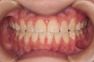 顎変形症の歯列矯正治療例2　終了時正面