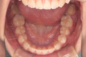 顎変形症の歯列矯正治療例2　終了時下顎咬合面