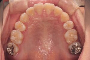 顎変形症の歯列矯正治療例2　終了時上顎咬合面