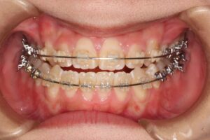 顎変形症の歯列矯正治療例2　治療中正面