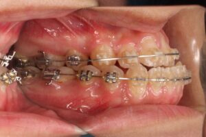 顎変形症の歯列矯正治療例2　治療中側面