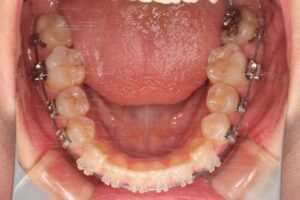 顎変形症の歯列矯正治療例2　治療中下顎咬合面