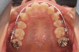 顎変形症の歯列矯正治療例2　治療中上顎咬合面